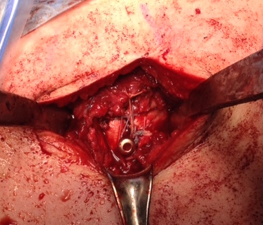 Greater tuberosity Tie over screw